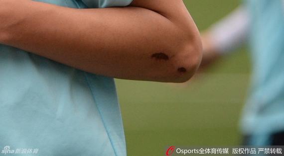 苏宁球员伤痕可见
