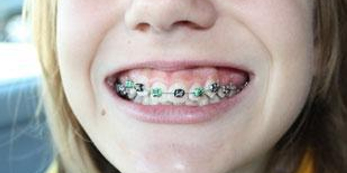 孩子正畸拔牙没那么可怕