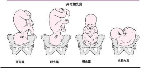 孕妈如何自己转胎成功?