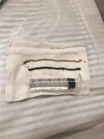 从男童阑尾中取出的手链(受访者供图)