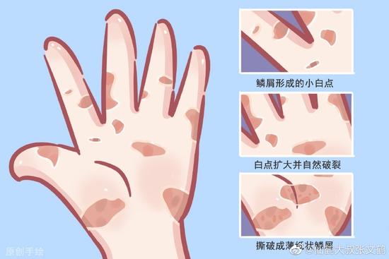剥脱性角质松解症