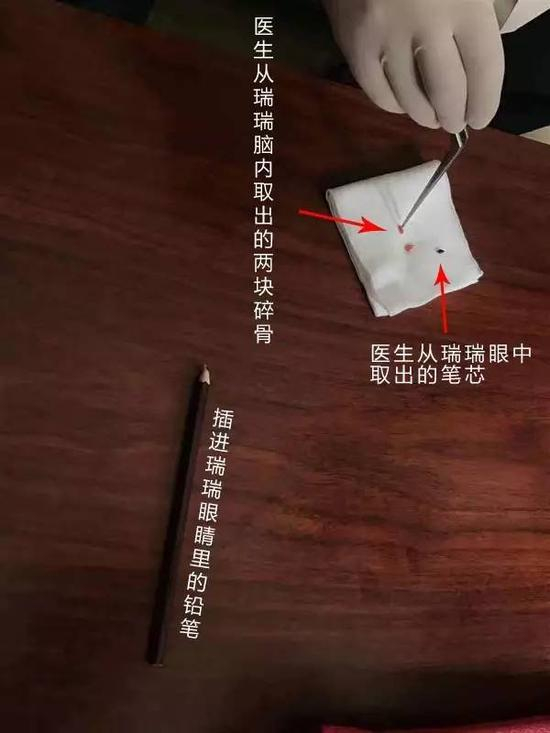 插入右眼的铅笔