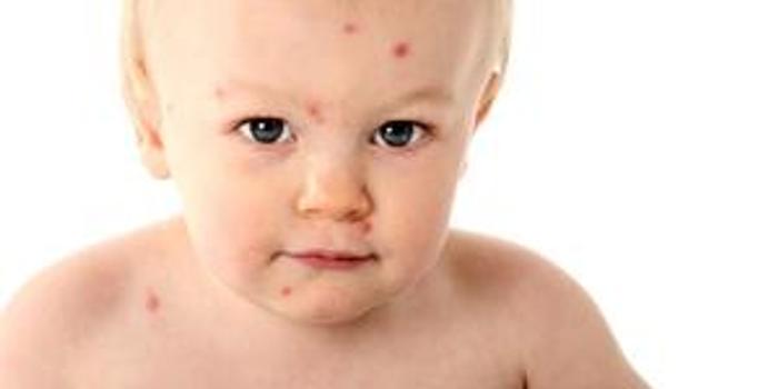 小儿春夏季接触性过敏性皮炎的防治