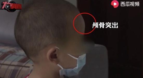 有孩子出现颅骨突出的问题。视频截图