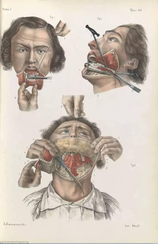 4。 1841年医生简单切除病人的脚趾尖端……没有麻醉剂……