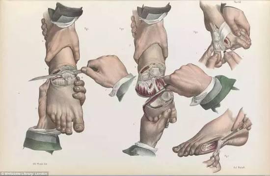 5、1840年没有麻醉剂的时代的剖腹产手术……