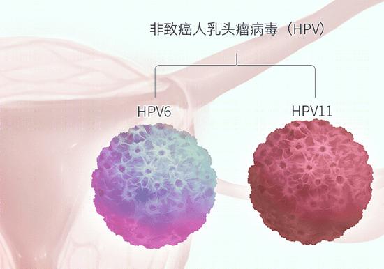 身上这4种皮肤疙瘩，要当心HPV感染