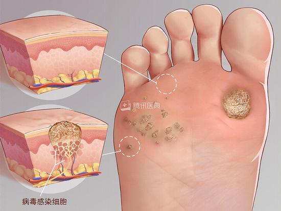 身上这4种皮肤疙瘩，要当心HPV感染