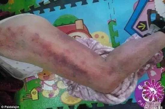 这是一名糖尿病人的腿,曾接受萧拍打疗法