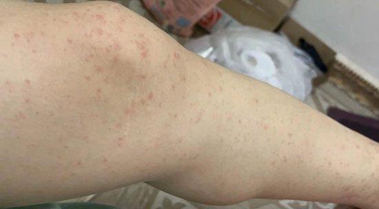 广东顺德累计报告基孔肯雅热确诊病例1161例 均为轻症病例