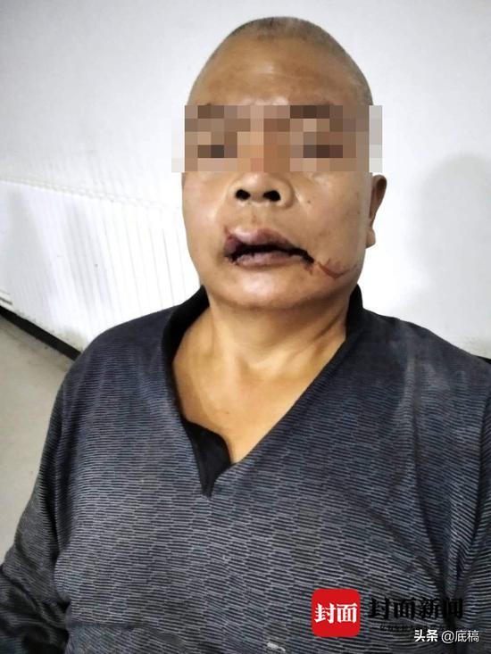 刁建立被打断七根肋骨