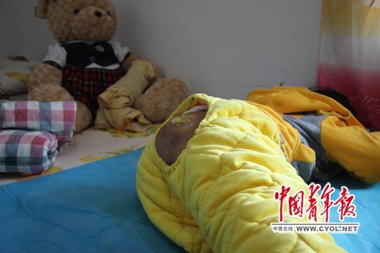 11月13日,记者在现场看到小武的伤口至今还未痊愈。章 正/摄