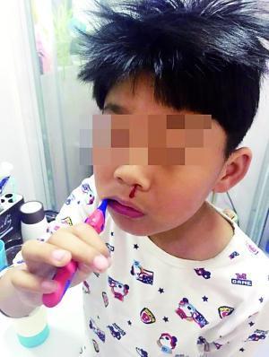 家长上传的自称孩子洗漱时无故留鼻血的照片。