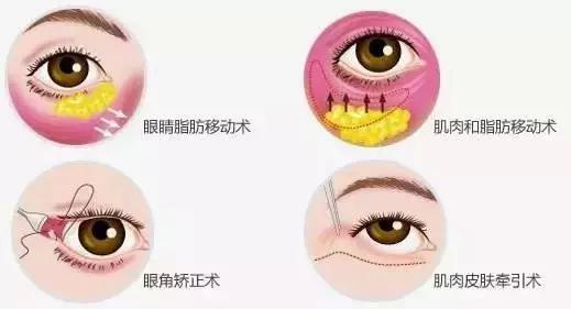 眼袋脂肪