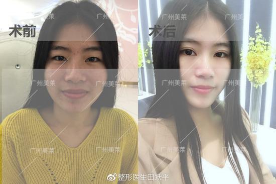 术后对比