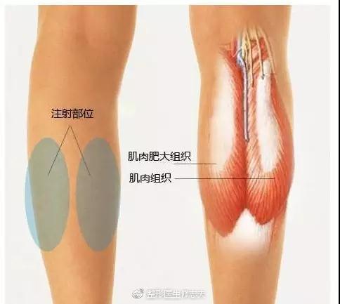 注射肉毒素