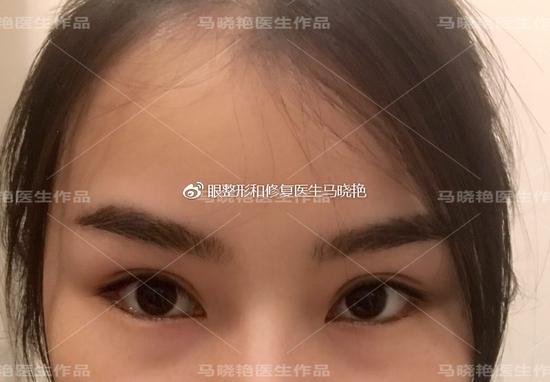 术后3个月