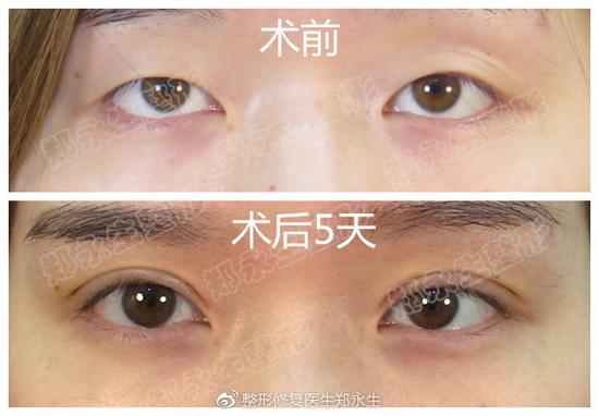 术后五天