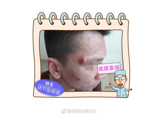 结节型痘痘