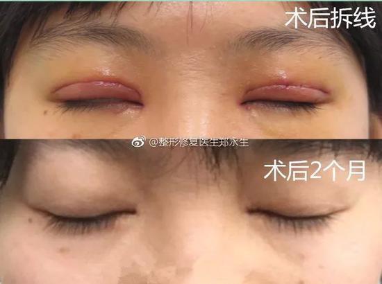 疤痕明显