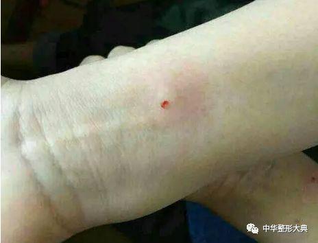 过敏试验