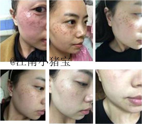 雀斑治疗后的变化过程(感谢@江南小猪宝 授权)