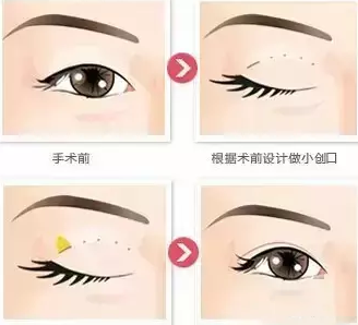 埋线法: