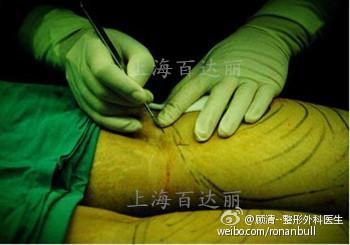 腘窝处做切口