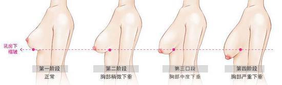 下垂