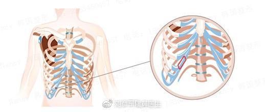 肋软骨