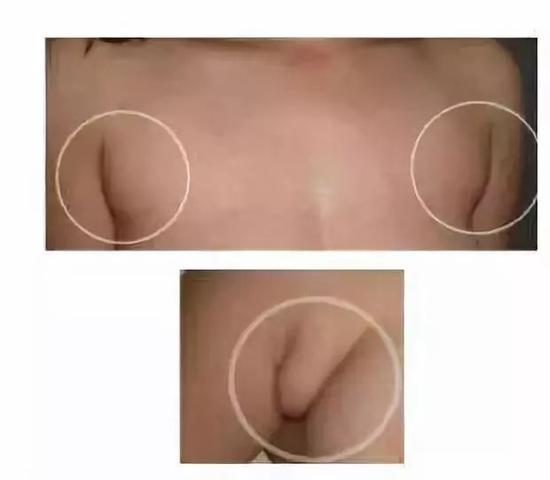 区分副乳