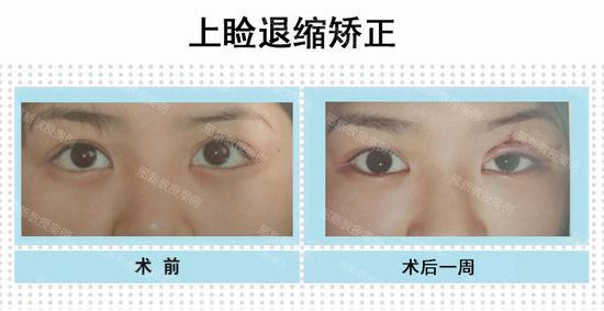 左上睑外伤后瘢痕性上睑退缩(图左)术后一周正位睁眼状态(图右)