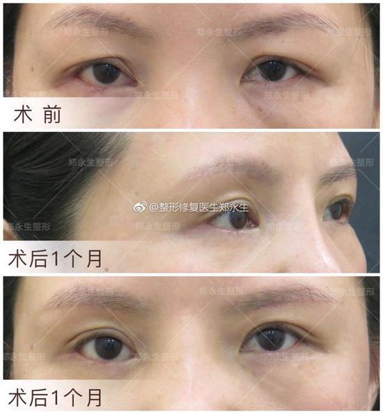 术后对比