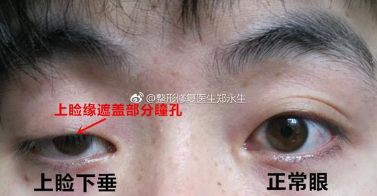上睑下垂