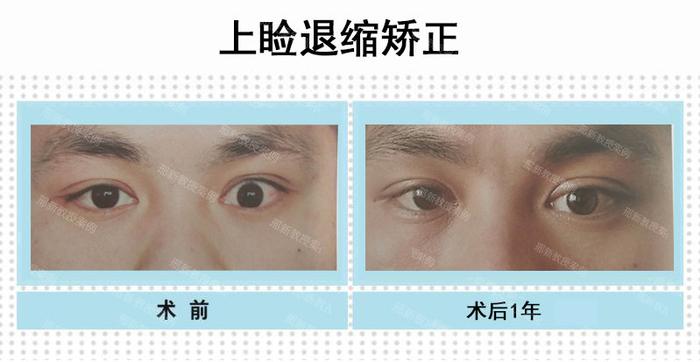 术前瘢痕性左上睑退缩,术前正位睁眼状态(图左)术后一年正位睁眼状态,左侧上睑位置恢复正常,两侧睑裂基本对称(图右)
