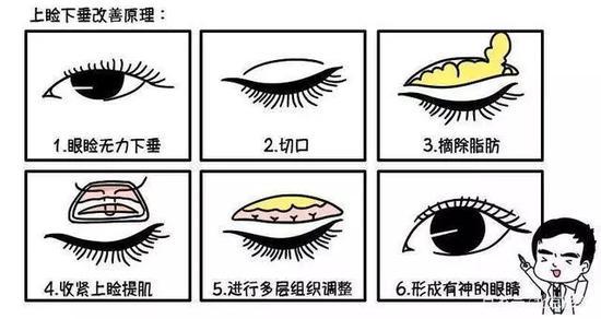 上睑下垂矫正术