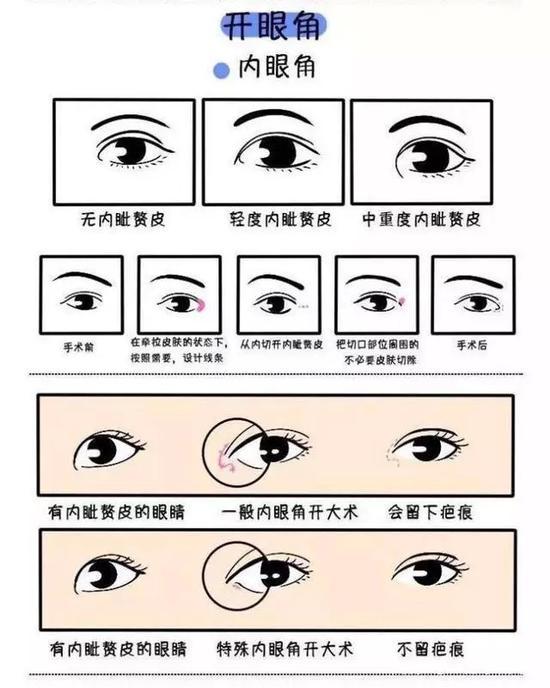 开眼角
