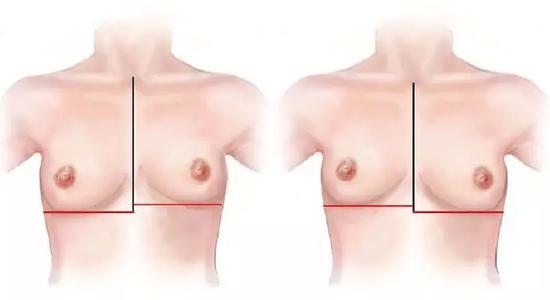 ▼不对称的乳房测量