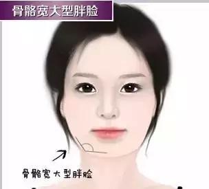 这种只能通过磨骨手术来瘦脸了!