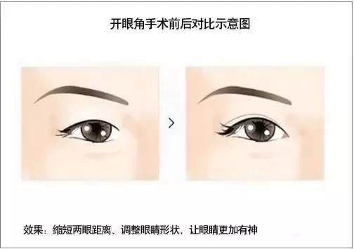 眼角