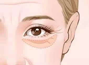 眼衰老