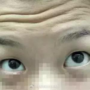 双眼皮失败会导致上睑下垂吗?