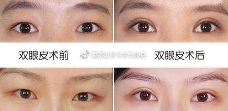 术后