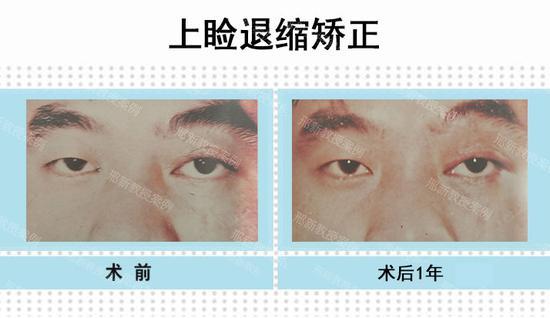 左上睑外伤后癞痕性上睑退缩(图左)术后一年正位睁眼状态(图右)