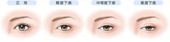 不同程度的上睑下垂
