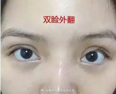 双睑外翻