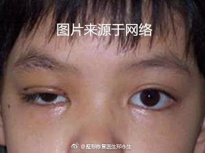 危害视力