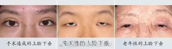 真性上睑下垂