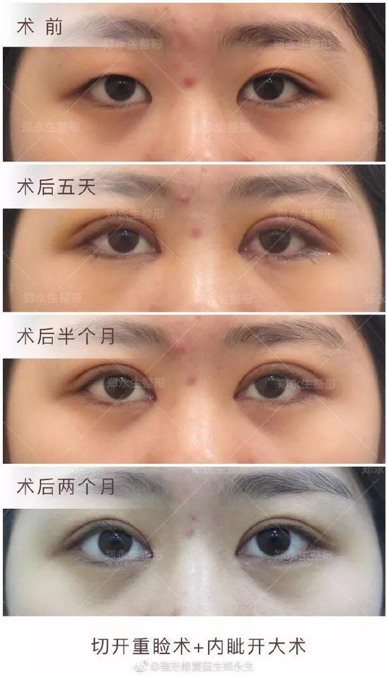 术后