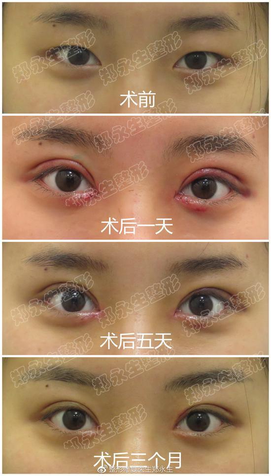 术后三个月
